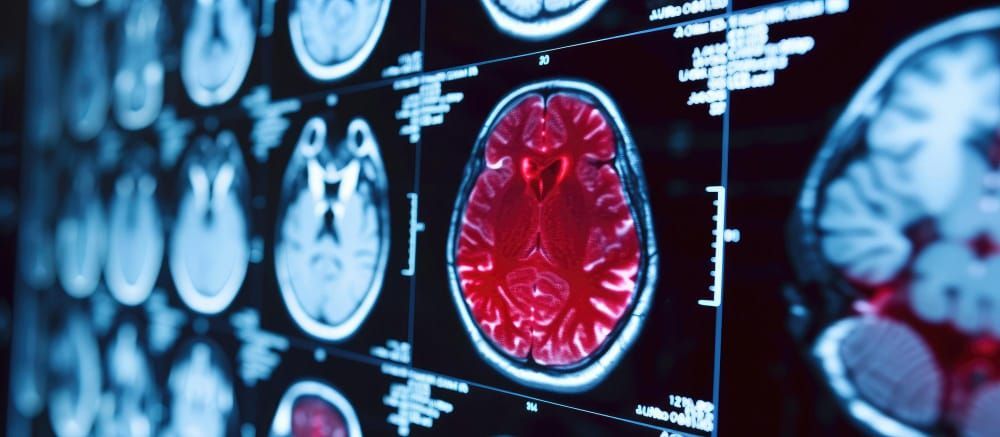 Patología Vascular Cerebral